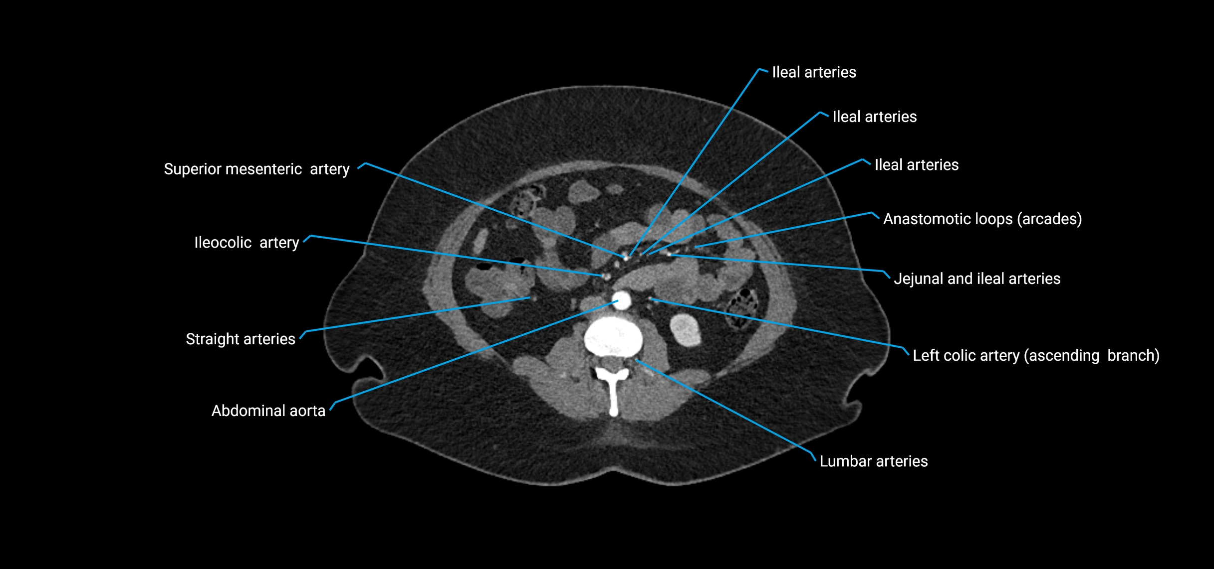 CTA abdomen axial cross sectional anatomy labelled image_101 (2).webp